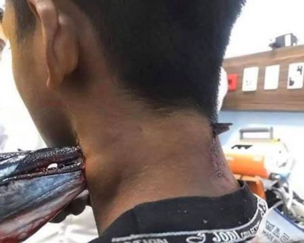 Peixe-agulha cravado no pescoço de adolescente na Indonésia - Foto: Reprodução/Facebook(Savage Paramedics)