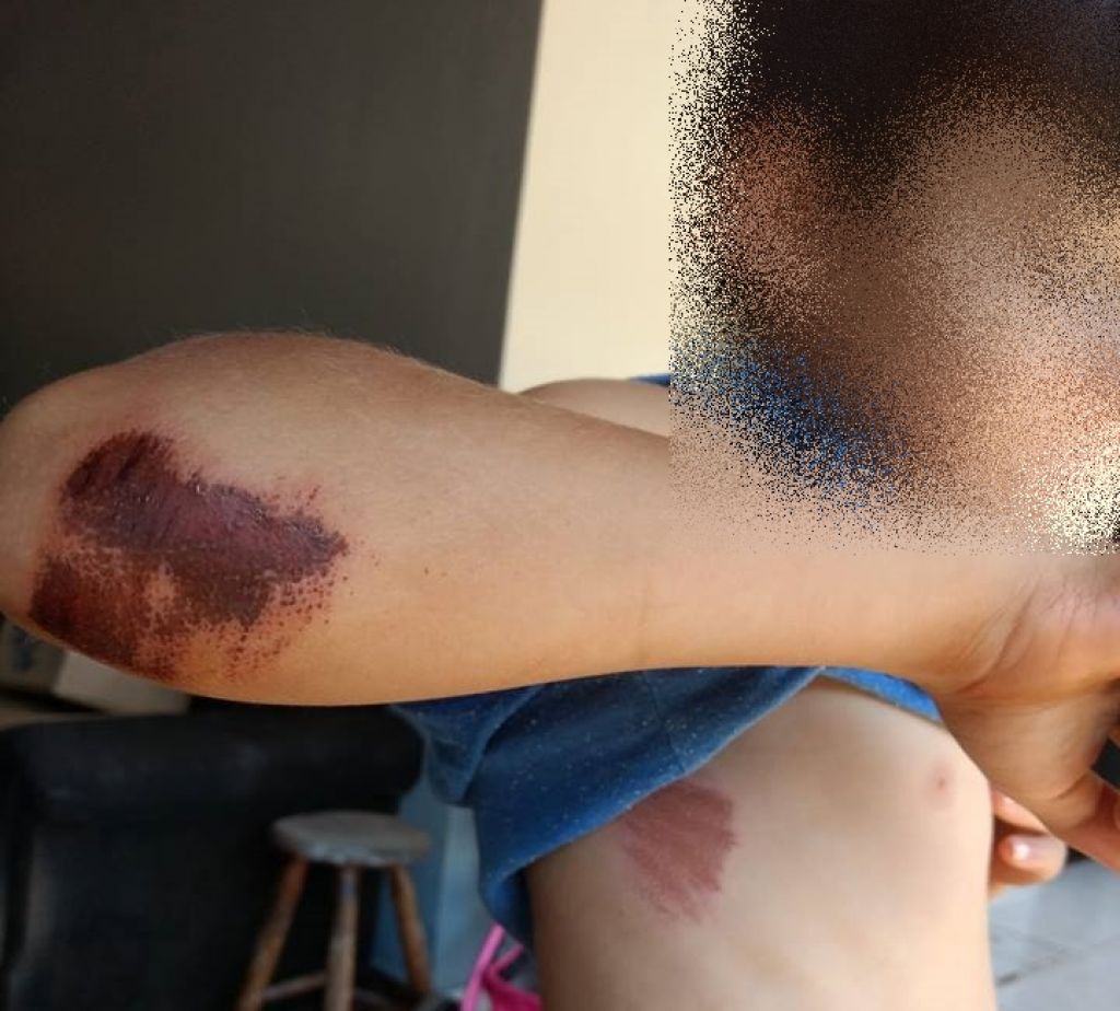 Criança se machucou ao cair de bicicleta em rua cheia de buraco no Jardim Vitória - reprodução/Facebook