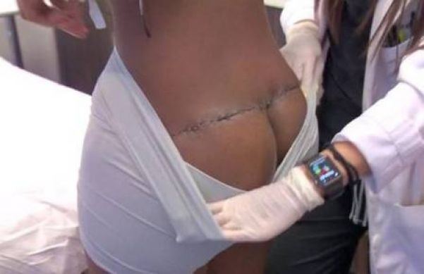 Jabrena após a cirurgia para correção - Foto: Reprodução/Botched