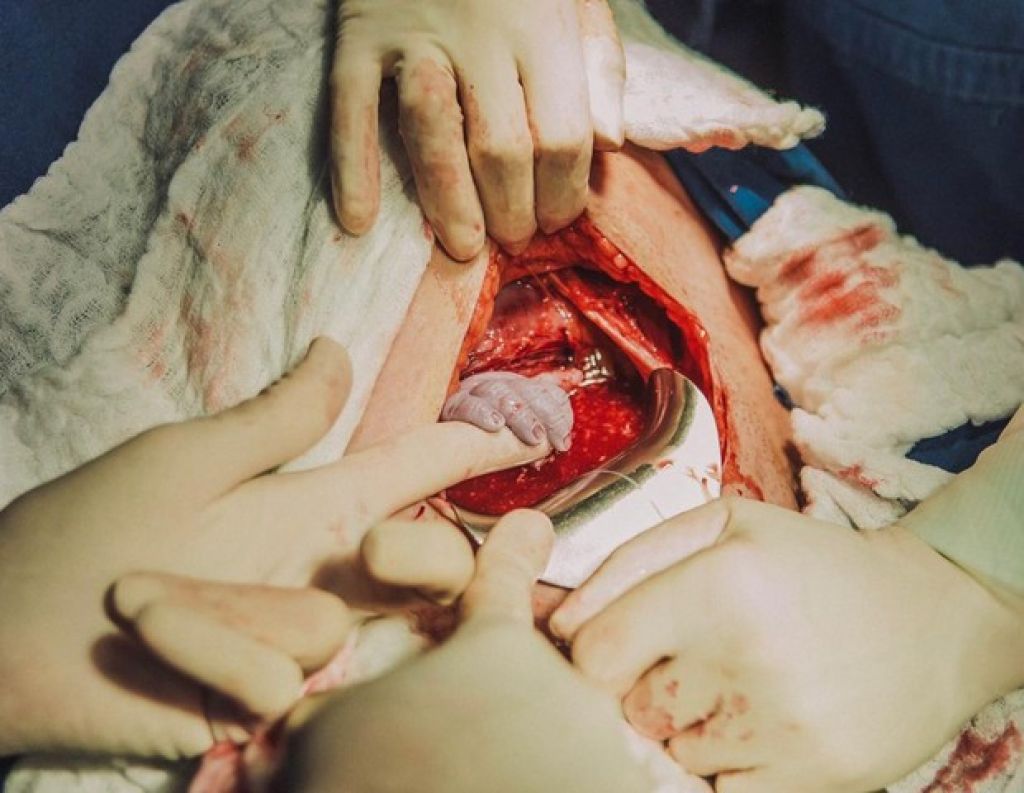 A pequena Luana segurando a mão da obstetra antes mesmo de nascer (Foto: Bruna Costa )