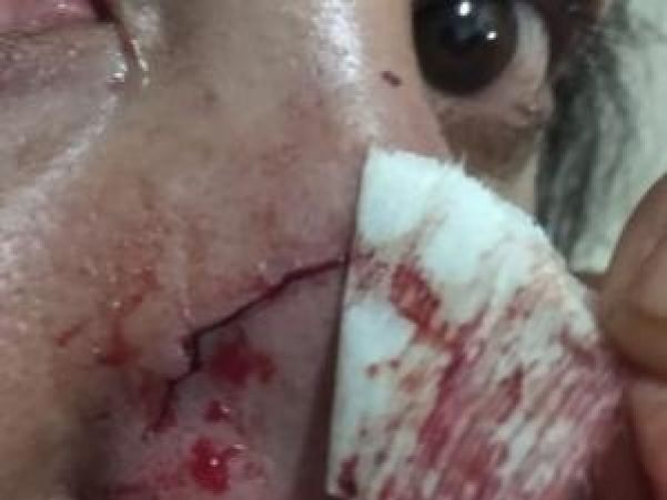 Mulher foi esmurrada e foi mordida no nariz (Foto: Jornal da Nova)