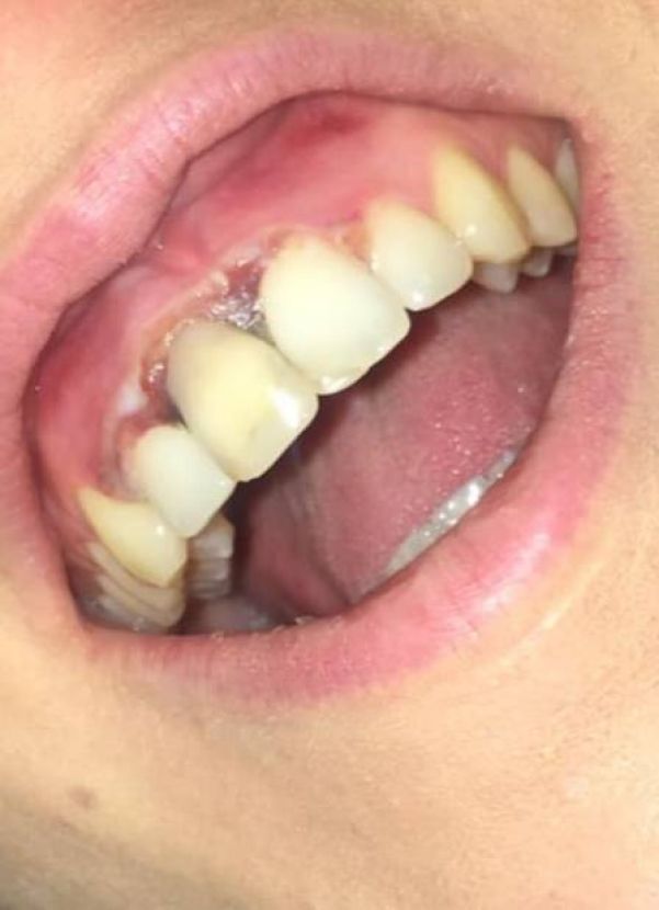 Mulher sofre queimadura em procedimento 'barato' para clarear os dentes - Foto: Reprodução/Facebook(Aoife Wills)