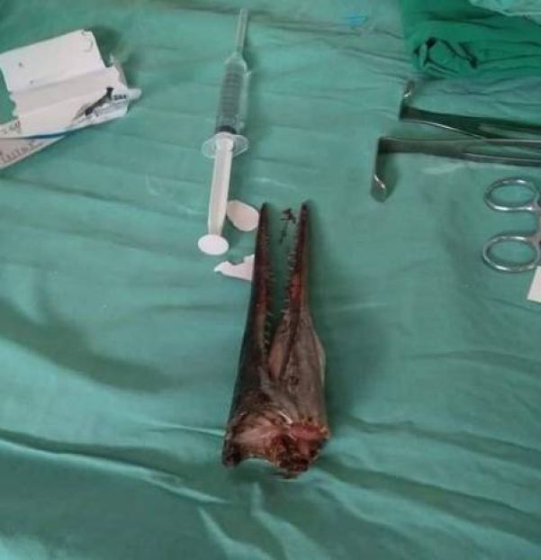 Bico de peixe-agulha retirado do pescoço de paciente - Foto: Reprodução/Facebook(Savage Paramedics)