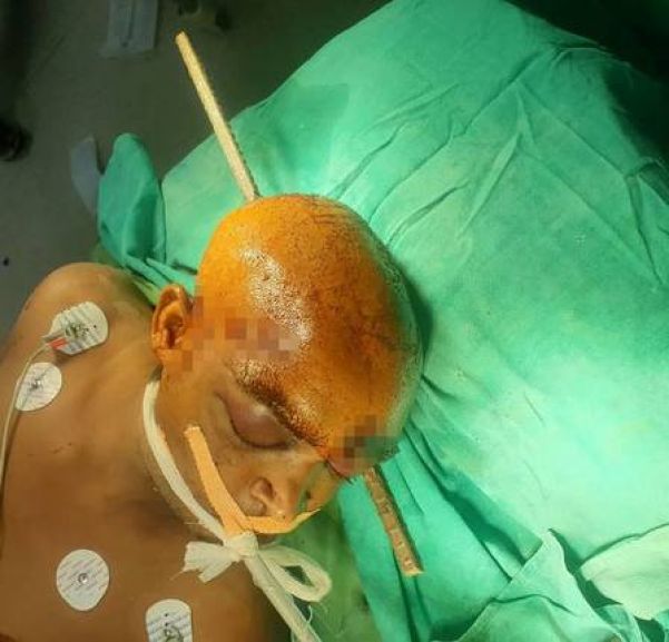 Barra de ferro atravessa a cabeça de operário na Índia Foto: Reprodução