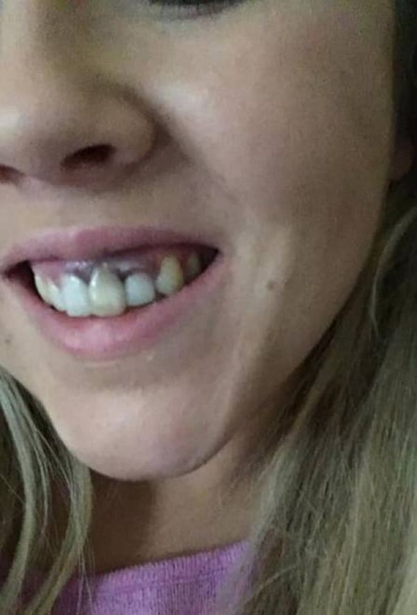 Mulher sofre queimadura em procedimento 'barato' para clarear os dentes - Foto: Reprodução/Facebook(Aoife Wills)