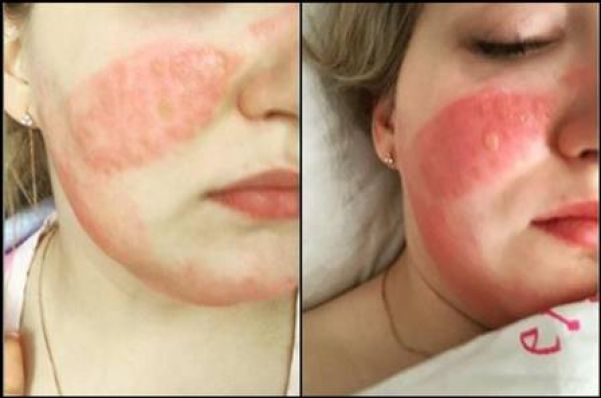 A enfermeira russa Olga Ovinnikova sofreu queimaduras no rosto - Foto: Instagram / Reprodução