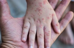 Síndrome provoca surgimento de pequenas bolhas  - Foto: Ministério da Saúde