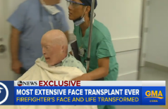 Como ficou a aparência do homem que fez um transplante facial?