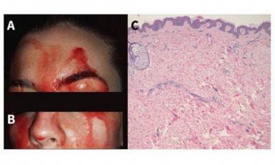 Sangramentos acontecem no rosto e nas palmas das mãos - REPRODUÇÃO/CMAJ