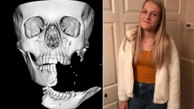 Imagem do crânio de Emily e a jovem um mês após o acidente (Foto: Reprodução/Sheffield Children’s NHS Foundation; arquivo pessoal