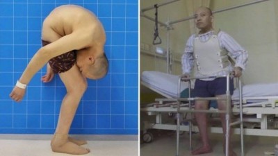 Li Hua antes e depois da cirurgia - Foto: Reprodução