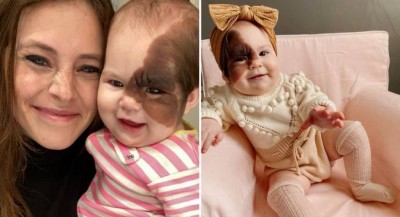 Nicole Hall explica que a filha Winry, de 13 meses, nasceu com uma marca rara no rosto ( Foto: REPRODUÇÃO/INSTAGRAM)