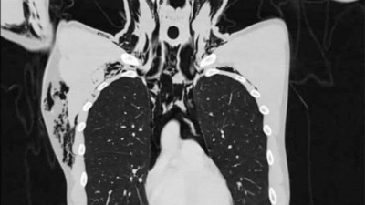 Mediastino frontal do tórax (Foto: Radiology Case Reports)