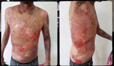 Homem teve queimaduras em aproximadamente 80% do corpo; Foto: Divulgação/PC