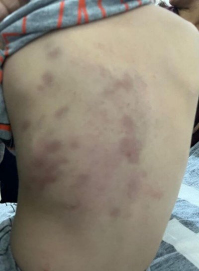 Hematomas nas costas da criança