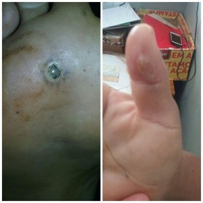 À esquerda o ferimento causado pelo raio no pé e à direta o dedo que foi atingido (Foto: divulgação/94FM