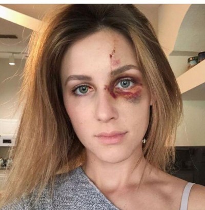 Brasileira agredida pelo namorado nos EUA faz alerta sobre relacionamento abusivo (Foto: reprodução/Instagran)