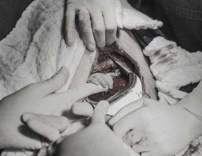 A pequena Luana segurando a mão da obstetra antes mesmo de nascer (Foto: Bruna Costa)