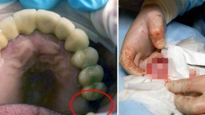Dente que faltava foi achado crescendo em testículo (Foto: Reprodução/East2West News)