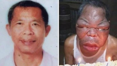 Romulo Pilapil antes e depois do quadro severo de sinusite Foto: Reprodução