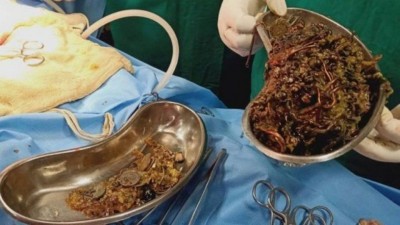 Metais retirados do estômago de paciente na Índia Foto: Reprodução