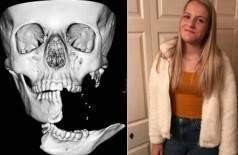 Imagem do crânio de Emily e a jovem um mês após o acidente (Foto: Reprodução/Sheffield Children’s NHS Foundation; arquivo pessoal