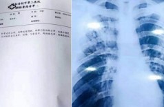 Diagnóstico de tuberculose falso acompanhado de radiografia com pulmões comprometidos pela doença (Foto: Reprodução)
