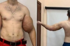 Kirill antes e depois da cirurgia - Foto: Reprodução