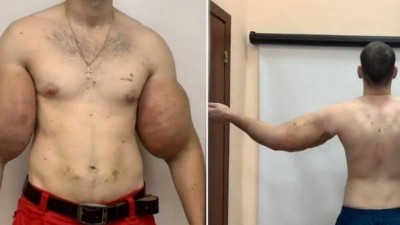 Kirill antes e depois da cirurgia - Foto: Reprodução