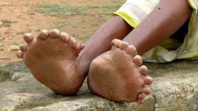 Indiana tem 19 dedos nos pés (Foto: Reprodução)