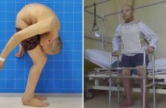 Li Hua antes e depois da cirurgia - Foto: Reprodução