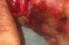 Motorista teve as duas mãos perfuradas por faca - Fotos: Divulgação