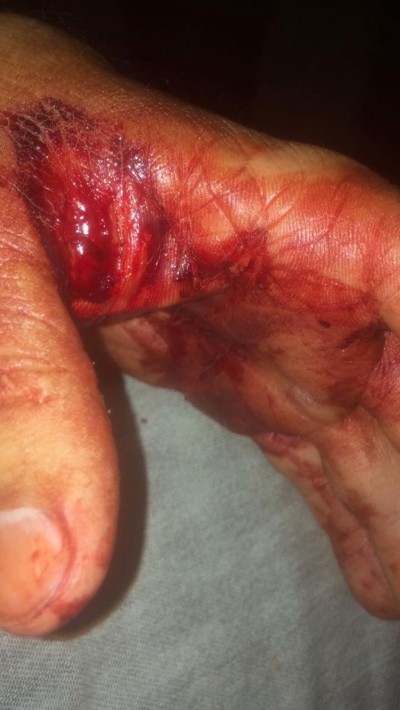 Motorista teve as duas mãos perfuradas por faca - Fotos: Divulgação