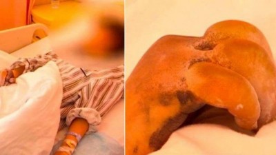 Aluna fica com 'dedos de banana' ao cavar gelo durante nevasca - Foto: Reprodução/Heilongjiang TV