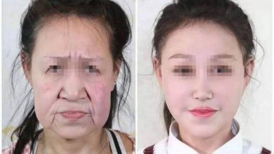 Adolescente de 15 anos tinha envelhecimento precoce - Foto: Shenyang Sunline Plastic Surgery Hospital