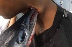 Peixe-agulha cravado no pescoço de adolescente na Indonésia - Foto: Reprodução/Facebook(Savage Paramedics)