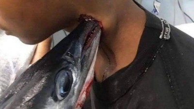 Peixe-agulha cravado no pescoço de adolescente na Indonésia - Foto: Reprodução/Facebook(Savage Paramedics)