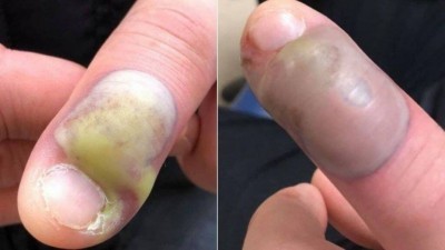 Paciente operada de emergência por causa do vício de roer as unhas - Foto: Reprodução/Facebook
