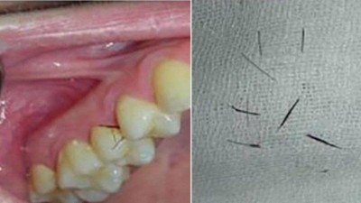 'Cílios' crescem nas gengivas de paciente na Itália (Foto: Reprodução/Oral Surgery, Oral Medicine, Oral Pathology and Oral Radiology)