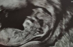 Bebê com 'rosto de Trump' em ultrassom Foto: Reprodução/Facebook(Hana Gilmour)