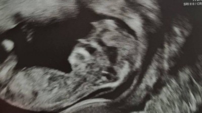 Bebê com 'rosto de Trump' em ultrassom Foto: Reprodução/Facebook(Hana Gilmour)