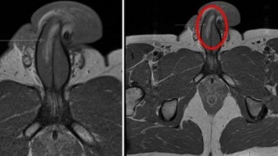 Em destaque, a área fraturada no pênis do paciente na Inglaterra (Foto: Reprodução/British Medical Journal)