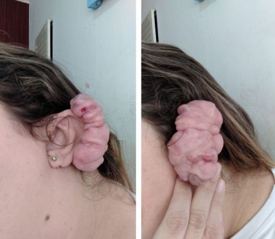 Joyce sofre com o problema desde a adolescência e agora pode encontrar solução (Foto: Divulgação)