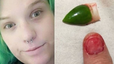 Mulher perdeu a unha verdadeira após acidente quando usava uma postiça de acrigel (Foto: Reprodução/Daily Star)