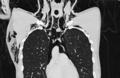 Mediastino frontal do tórax (Foto: Radiology Case Reports)