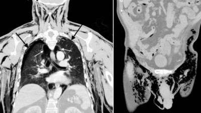 Homem é levado a emergência com raro quadro de 'pneumoescroto' (Foto: Reprodução/American Journal of Case Reports)