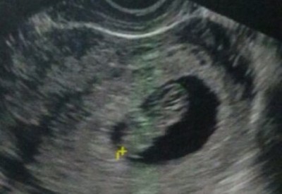 Concurso: gestante tem direito a exame físico em outra data