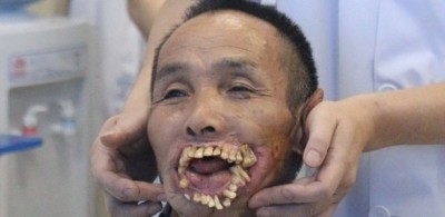 Cirurgia de Xiuyou Wu, 65, vai reconstruir lábios usando músculos das pernas (Reprodução)