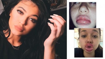 Desafio na internet faz meninas ficarem com os lábios deformados