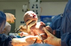 A taxa de lesões para os bebês em posição invertida que nasceram de cesárea é menor (Getty Images)